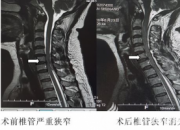 【今日朝陽網(wǎng)】厲害！他們消滅了潛伏在頸椎管里的“腫瘤君”（范廣明）